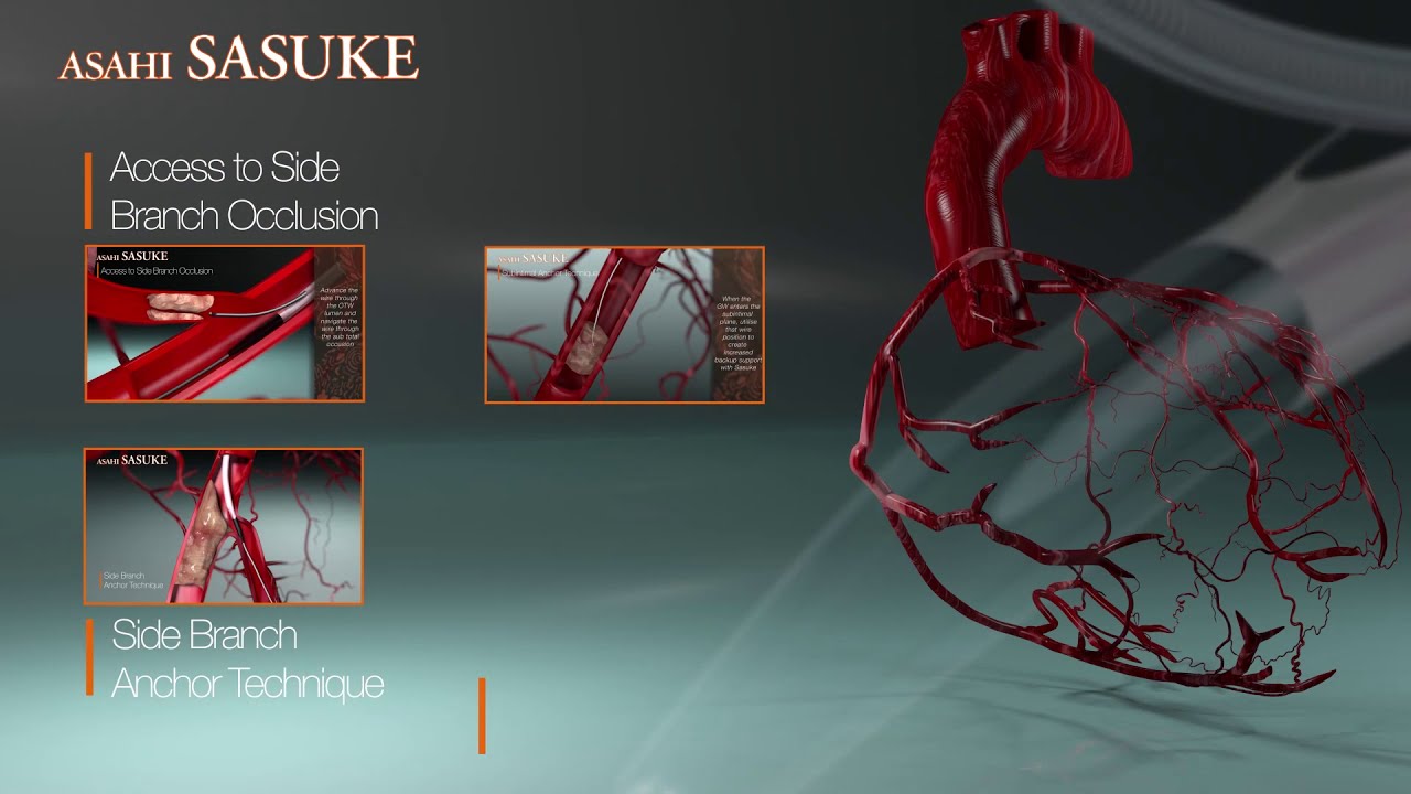 ASAHI SASUKE Double Lumen Catheter Introduction Video