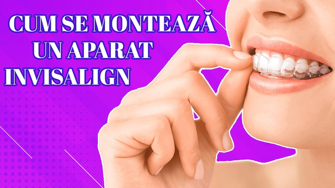 CUM SE MONTEAZA UN APARAT INVISALIGN?