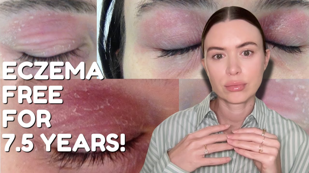 3 СОВЕТА, КАК Я ВЫЛЕЧИЛА ЭКЗЕМУ НА 7,5 ЛЕТ!