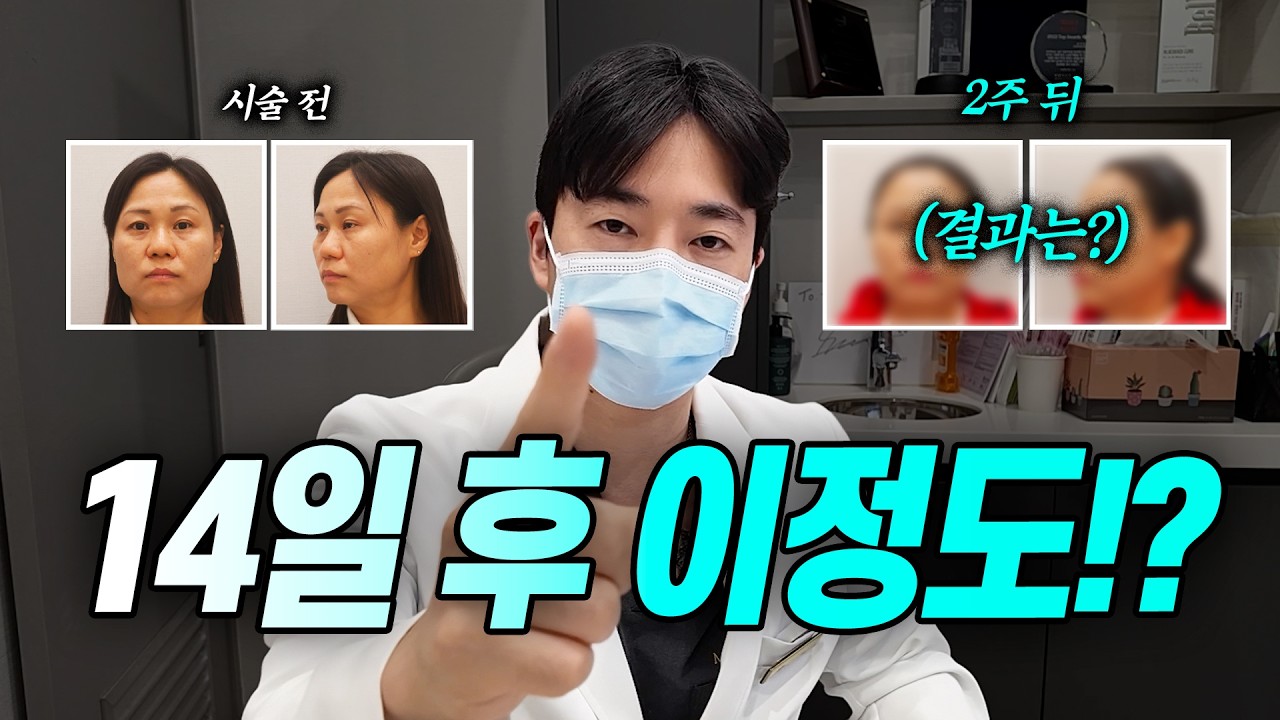 실리프팅 2주만에 턱라인, 볼꺼짐 변화 리얼 공개!