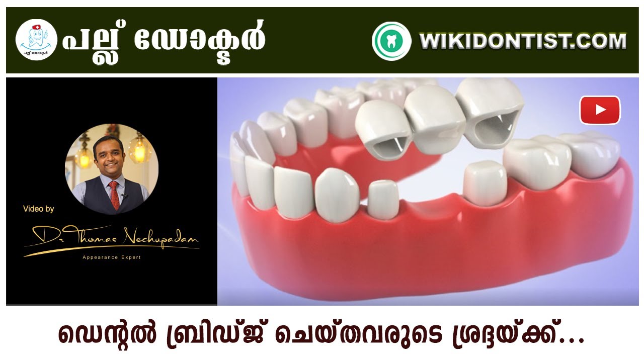 ഡെന്റൽ ബ്രിഡ്ജ് ചികിത്സ ചെയ്തവരുടെ ശ്രദ്ദയ്ക്ക്...Follow up after DENTAL BRIDGE Treatments...