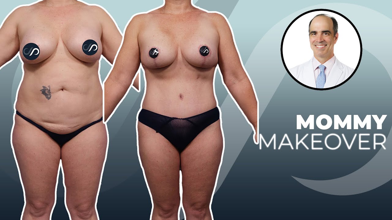 Mommy Makeover Post-op | Dr. David Stoker | Los Angeles, CA