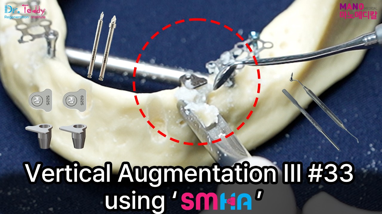 Vertical Augmentation III #33 using 'SMHA' Space Making Abutment