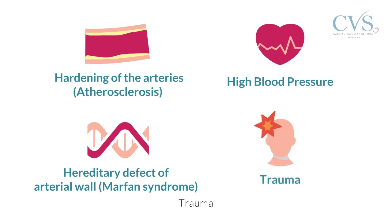 CVSKL: Abdominal Aortic Aneurysm (AAA) Education Video