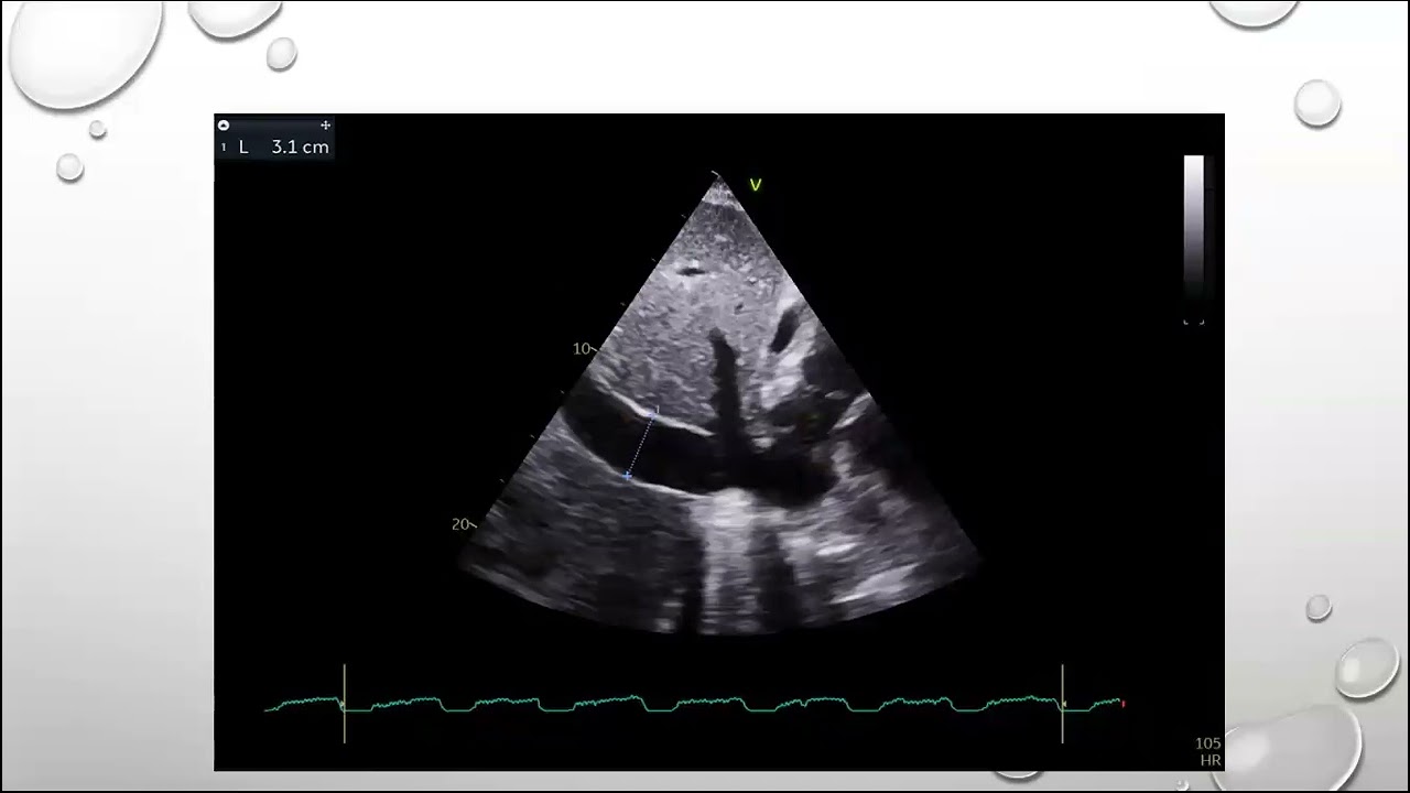 27-12 echo conference constrictive pericarditis