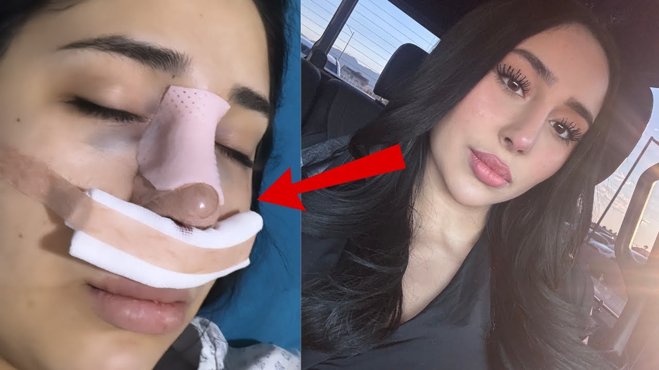 I GOT A 2ND NOSE JOB + Mexico Vlog