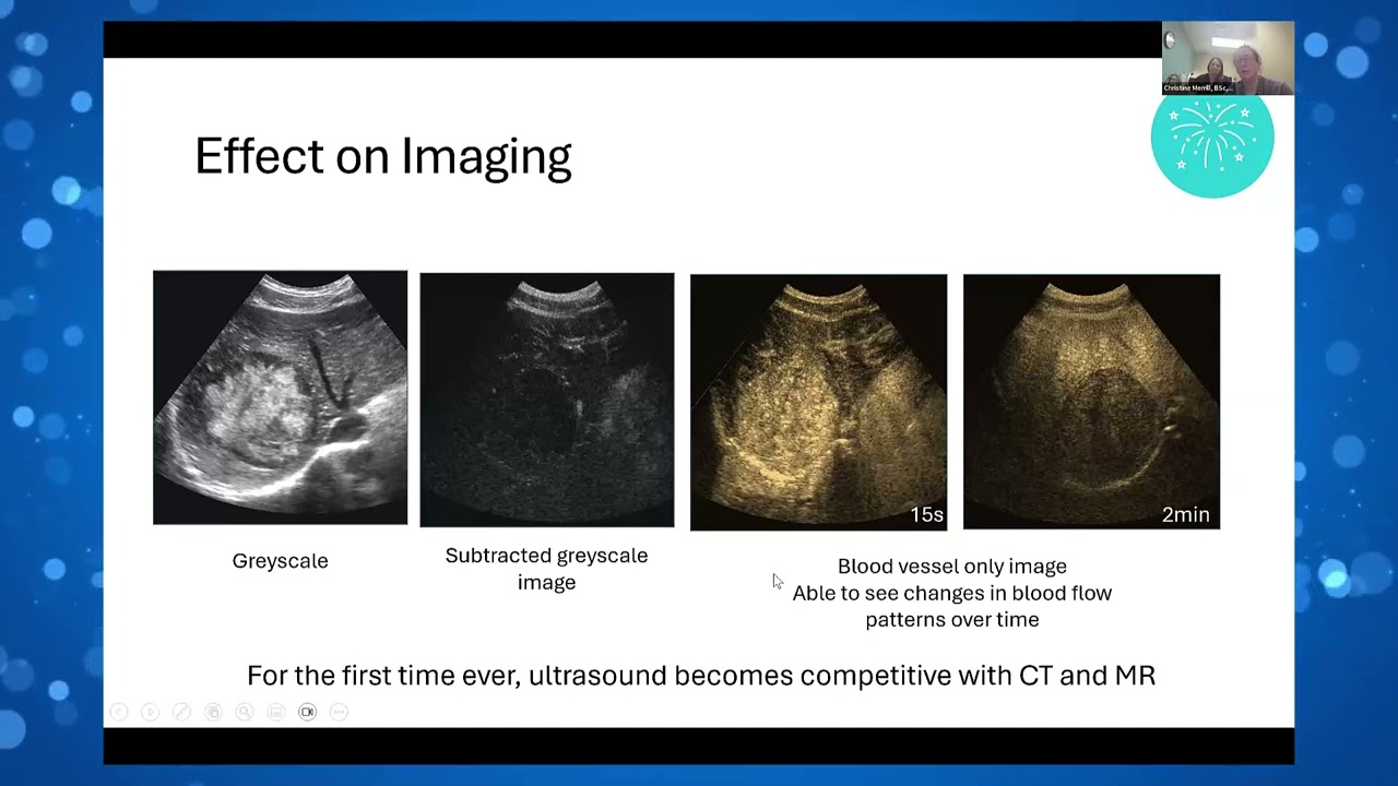 How Do You Get Those Images Optimization for CEUS Liver Mass