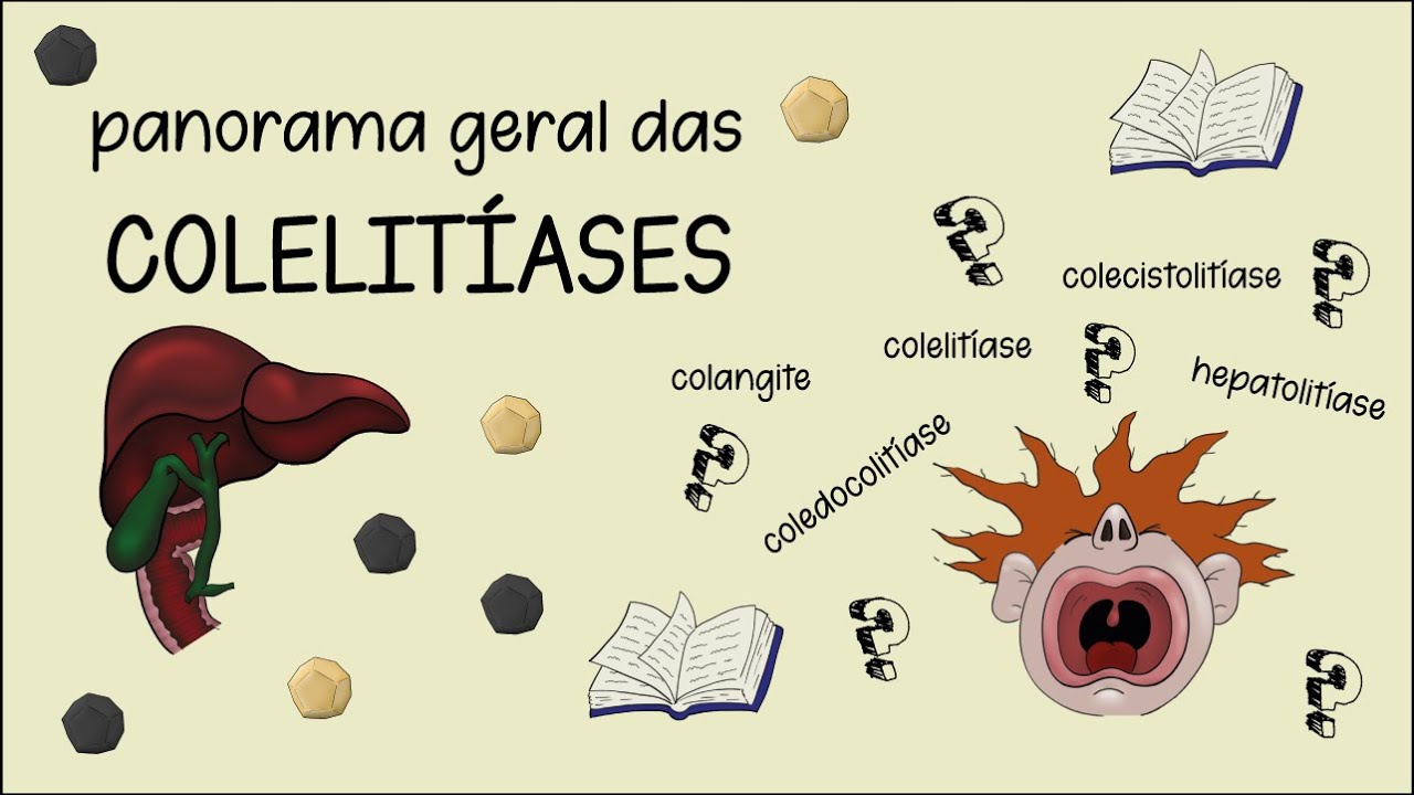 Introdu&ccedil;&atilde;o a Colelit&iacute;ase (coledocolit&iacute;ase, colangite, colecistites, s&iacute;ndrome de Mirizzi)
