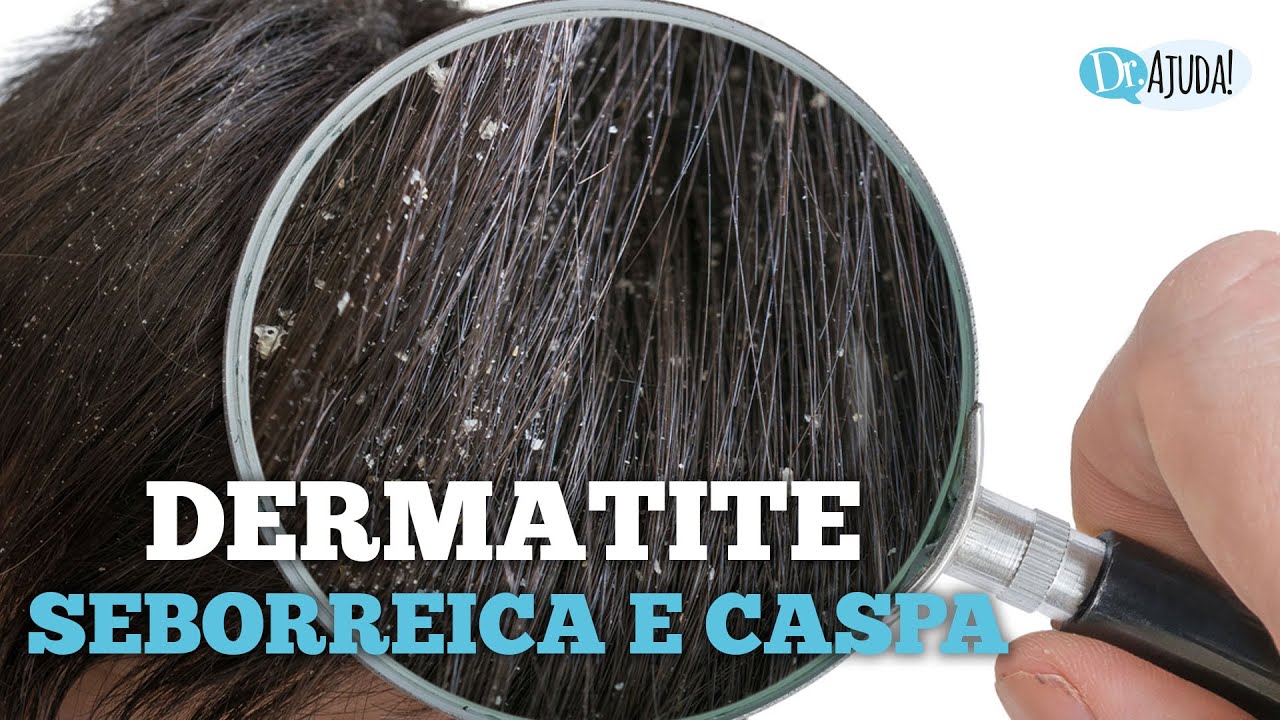 DERMATITE SEBORREICA E CASPA: QUAIS SÃO AS CAUSAS E O QUE FAZER?