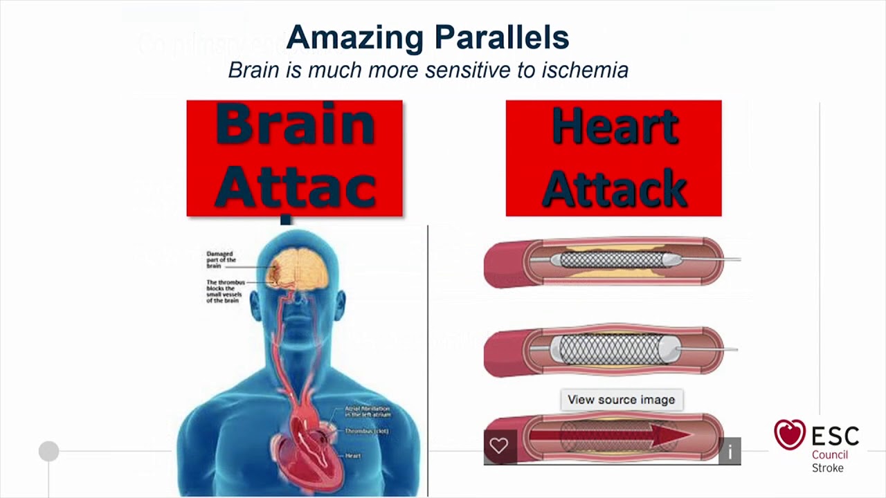 Innovation… the future of acute stroke treatment North American perspective - L.Nelson Hopkins