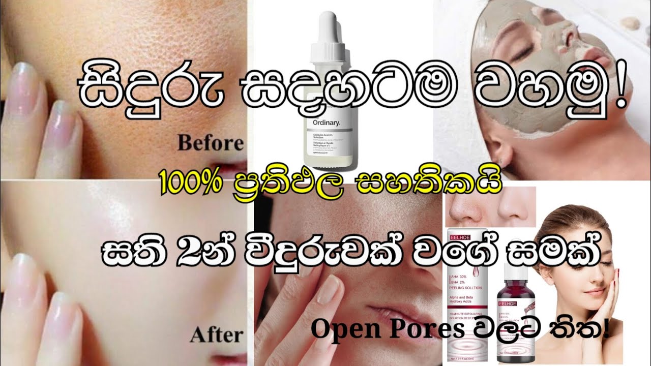 සමේ සිදුරු (Open Pores) සදහටම පාලනය කරගමු - ලංකාවේ තියෙන හොඳම විසඳුම් මෙන්න_@p.p_Journey_Of_Life 
