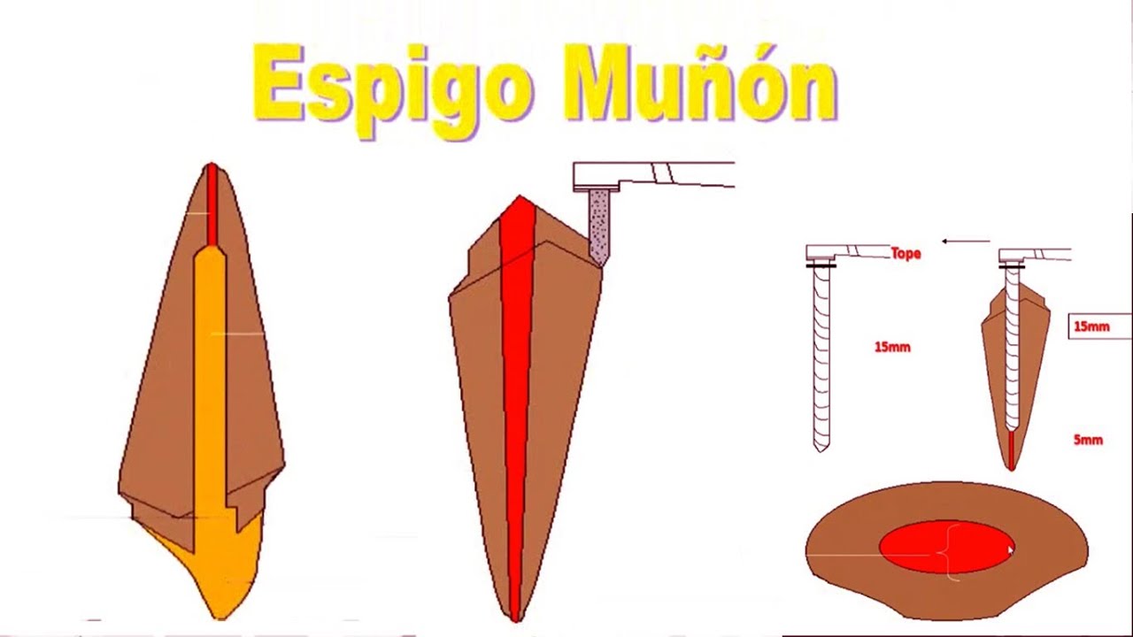 Espigo muñón
