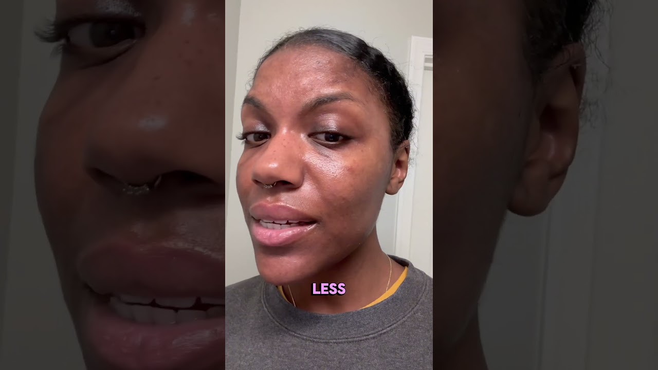 Kojic acid soap bar skin peeling results week 2 Hyperpigmentation/Melasma. Using Kojie San soap
