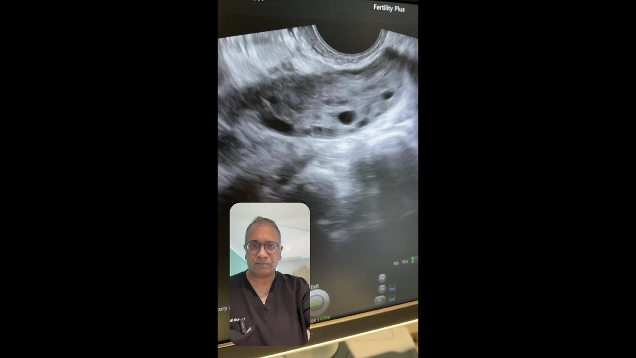 PCOS- LETROZOLE FAILED