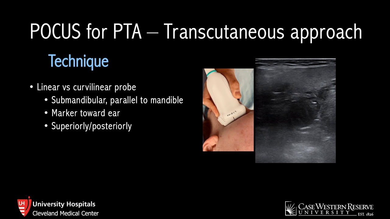Ultrasound for Peritonsillar Abscess