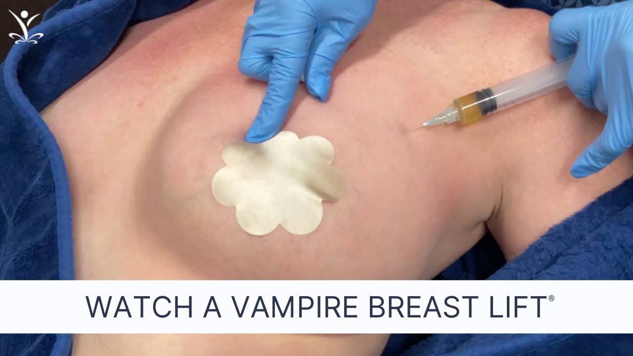Non-Surgical Breast Lift for Better Cleavage and Natural Lift