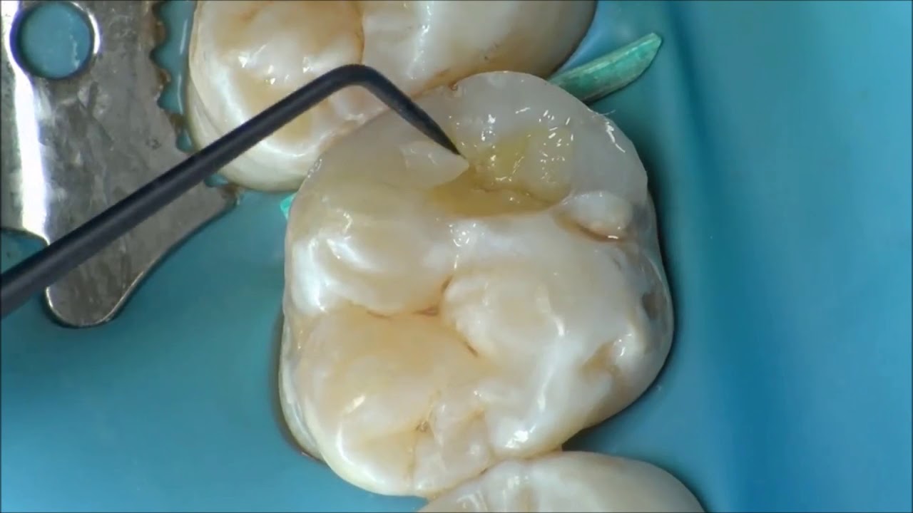 How to create a posterior restoration with two Mosaic composite shades