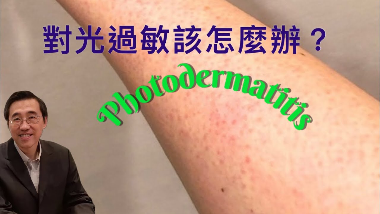《對光過敏該怎麼辦？》｜Photodermatitis