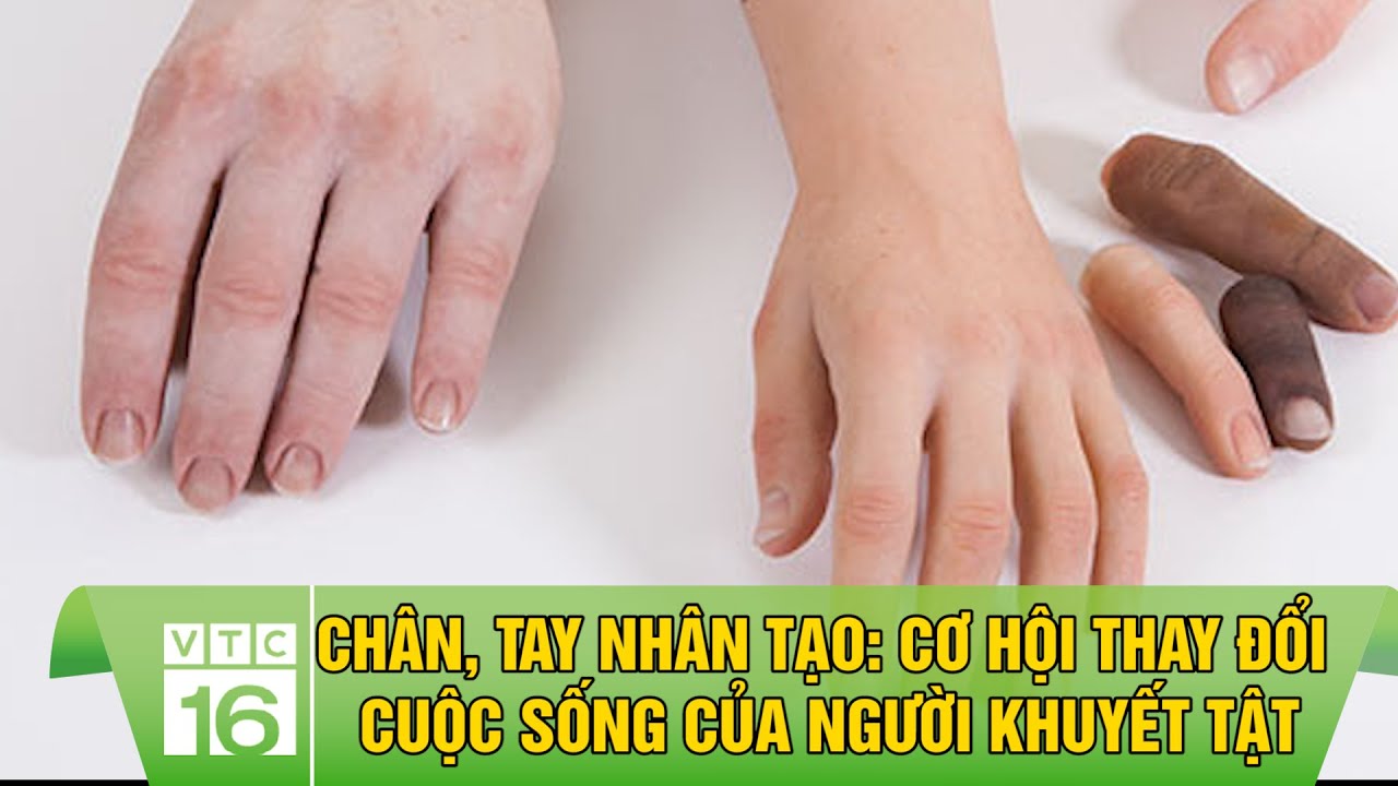 Chân, tay nhân tạo: Cơ hội thay đổi cuộc sống của người khuyết tật | VTC16