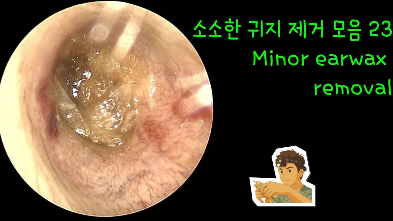 소소한 귀지 제거 모음 23 (Minor earwax removal)