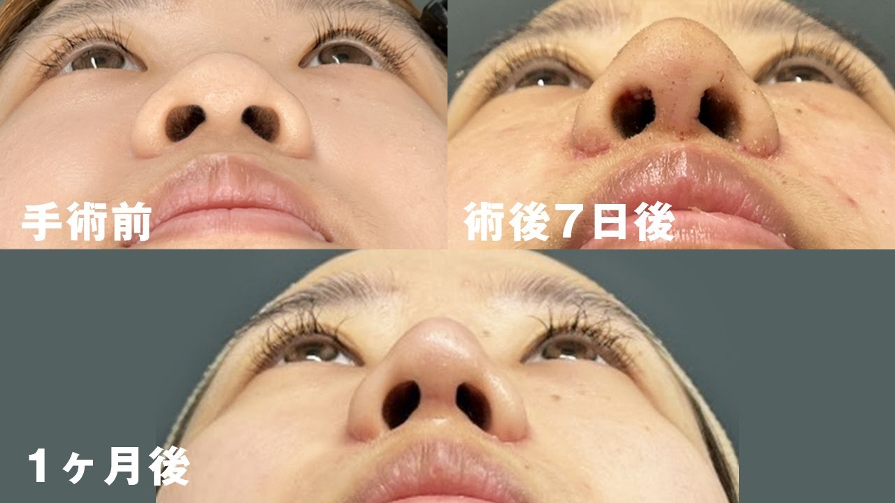 【鼻整形ダウンタイム】鼻尖形成、鼻プロテーゼ、小鼻縮小の経過と結果に密着