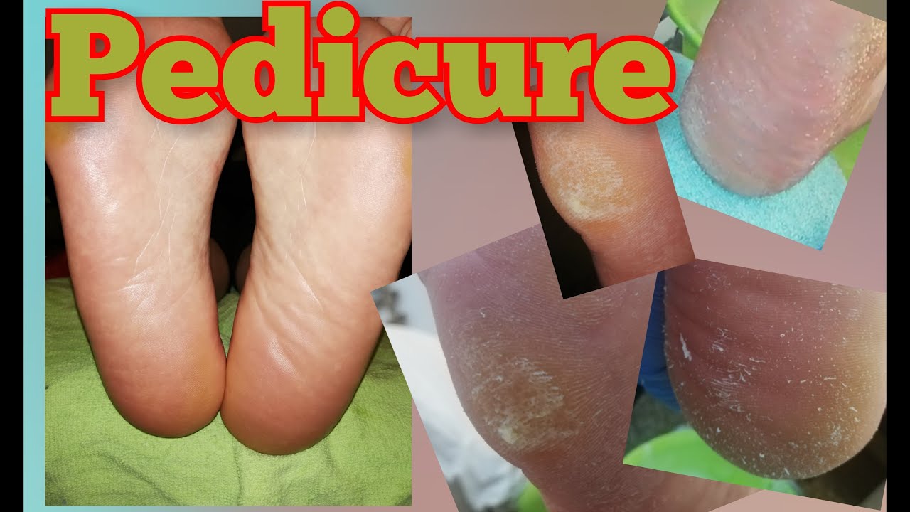 حف لحم ميت بالتفصيل. تعلم تنظيف اظافر القدمين. Pedicure بدكير الجزء ١