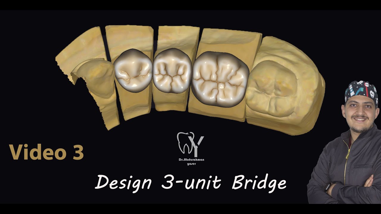 how to design 3 unit bridge on exocad? كيفية تصميم كوبري علي برنامج الexocad