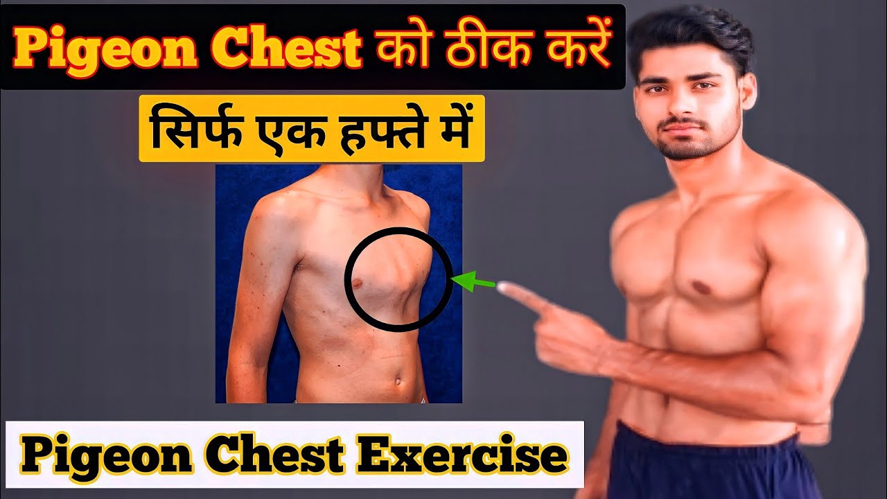 Pigeon Chest Workout | Pigeon Chest ko kaise thik kare | Pigeon chest Exercise | Pectus Carinatum |