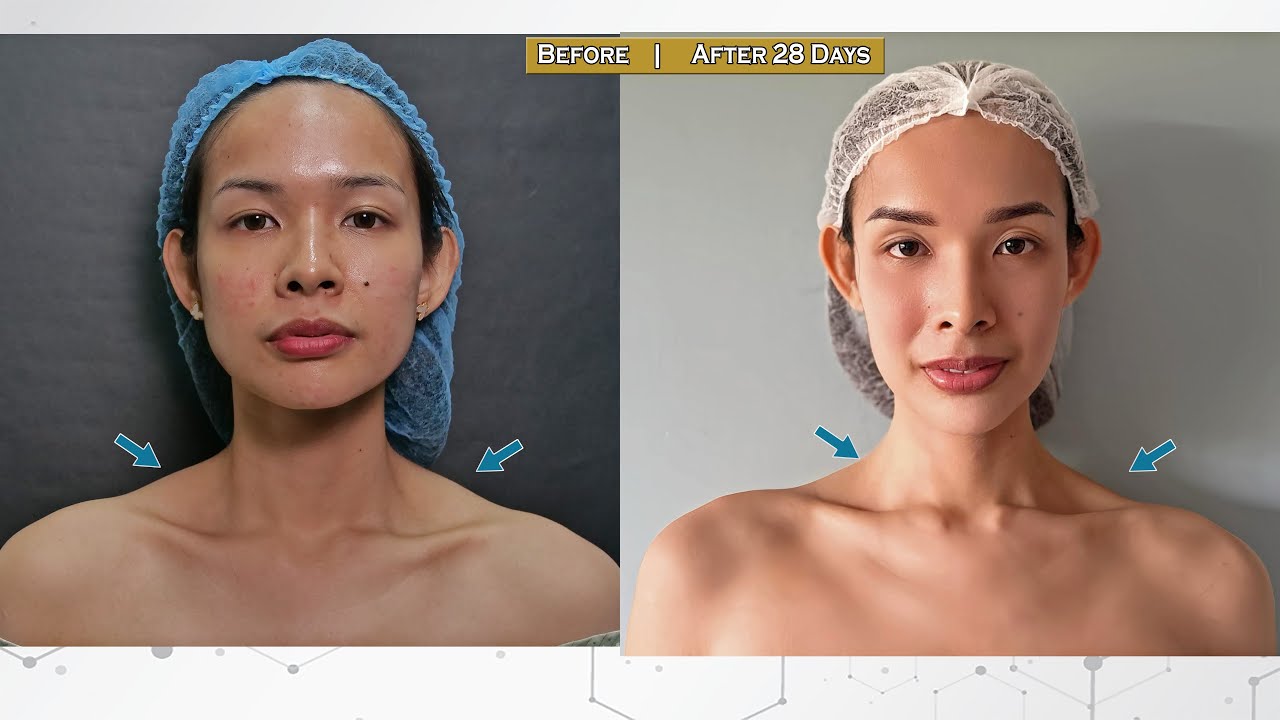 Mesotox for hyperhidrosis, oily skin and large pores, JAWTOX, TRAPTOX & CALFTOX, Eladerm