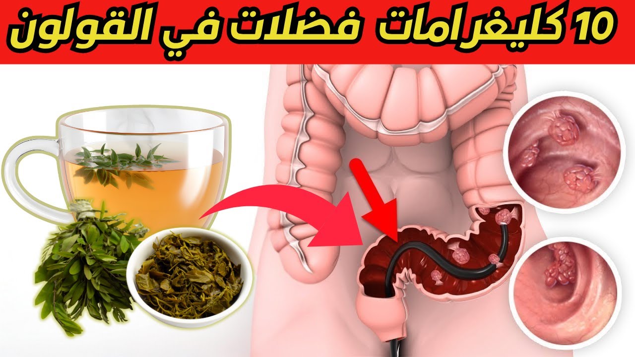5 اعشاب تنطف  القولون من البراز المتحجر والفضلات السامة