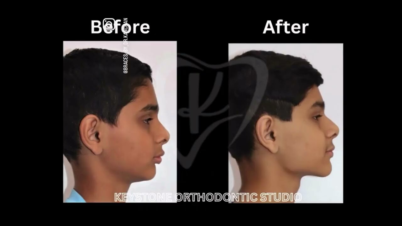 The Right choice at the right age .... Can do wonders for your face