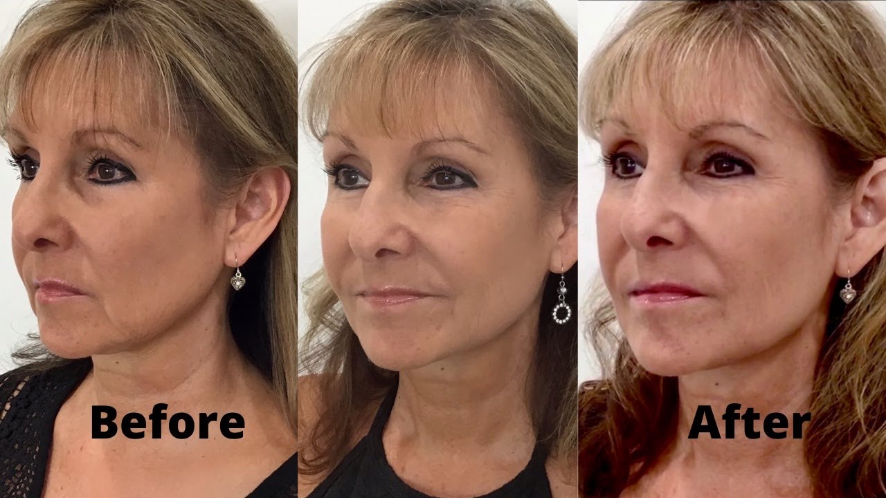 How to Get Rid of Jowls with Dermal Fillers! Step 3