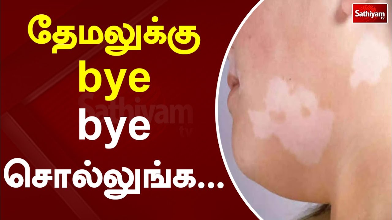 தேமல் மறைய மருத்துவ டிப்ஸ்   | Web Special | Sathiyam Tv