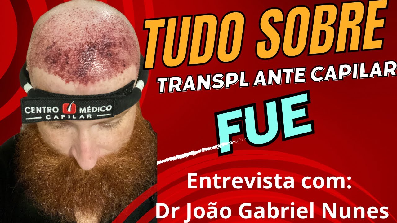 Tudo sobre transplante capilar Fue