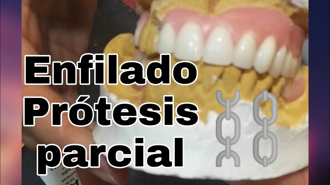 Enfilado Prótesis parcial superior