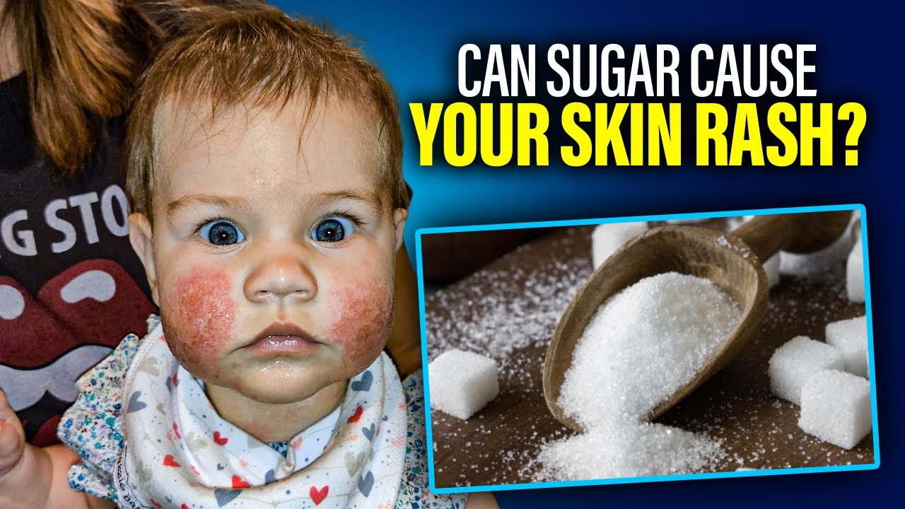 Can Sugar Cause Skin Rashes? ||  Dr Lonnie Herman