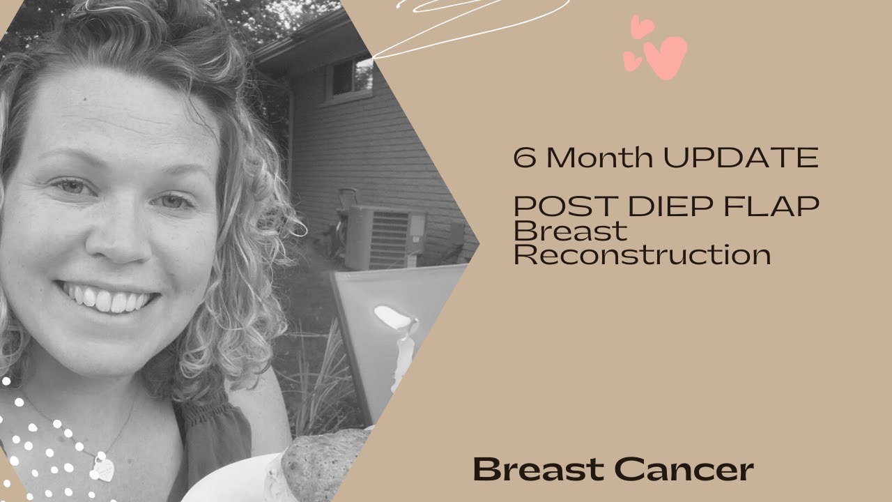 6 month post DIEP update