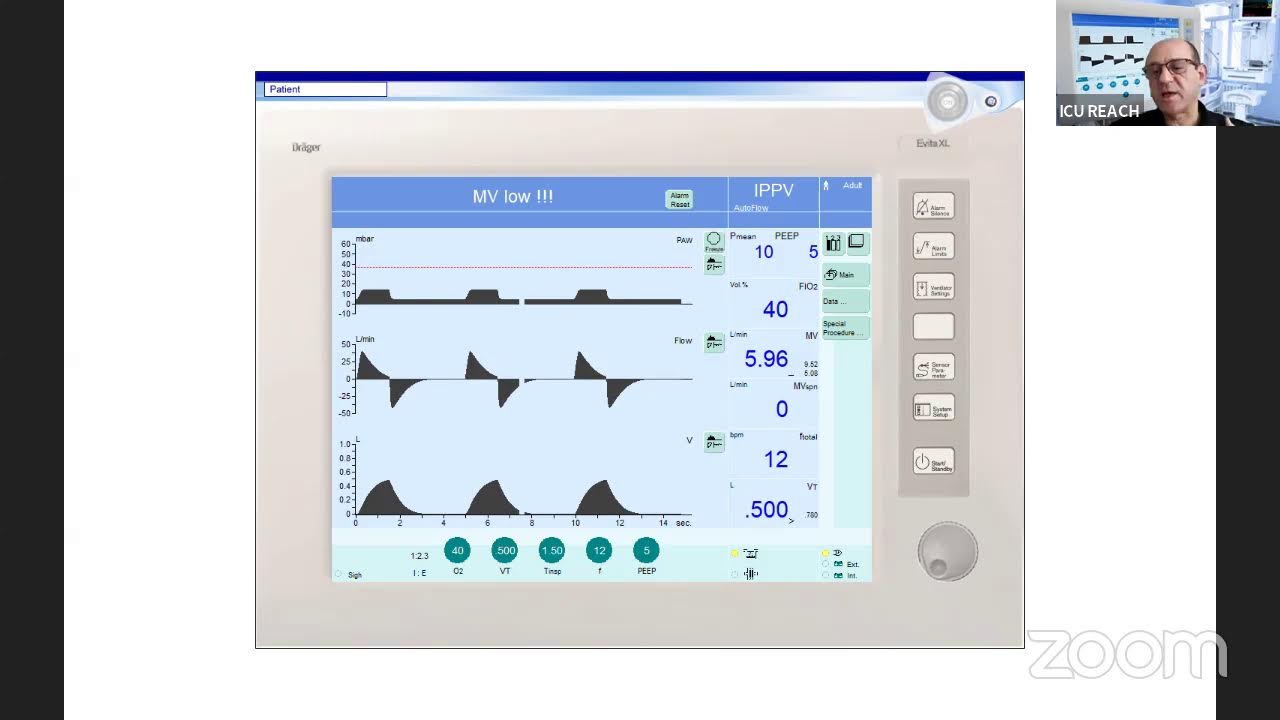 Pressure Regulated Volume Control (PRVC)