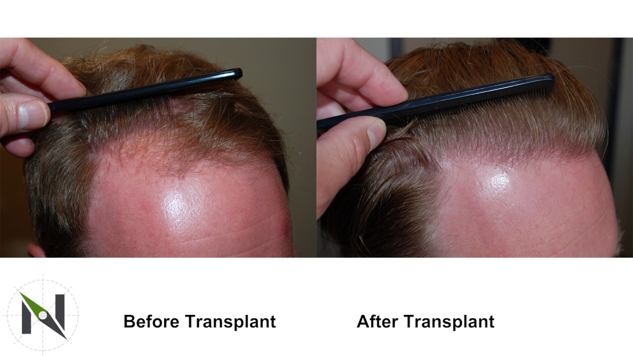Creating A Natural Looking Hairline with Hair Transplant Surgery