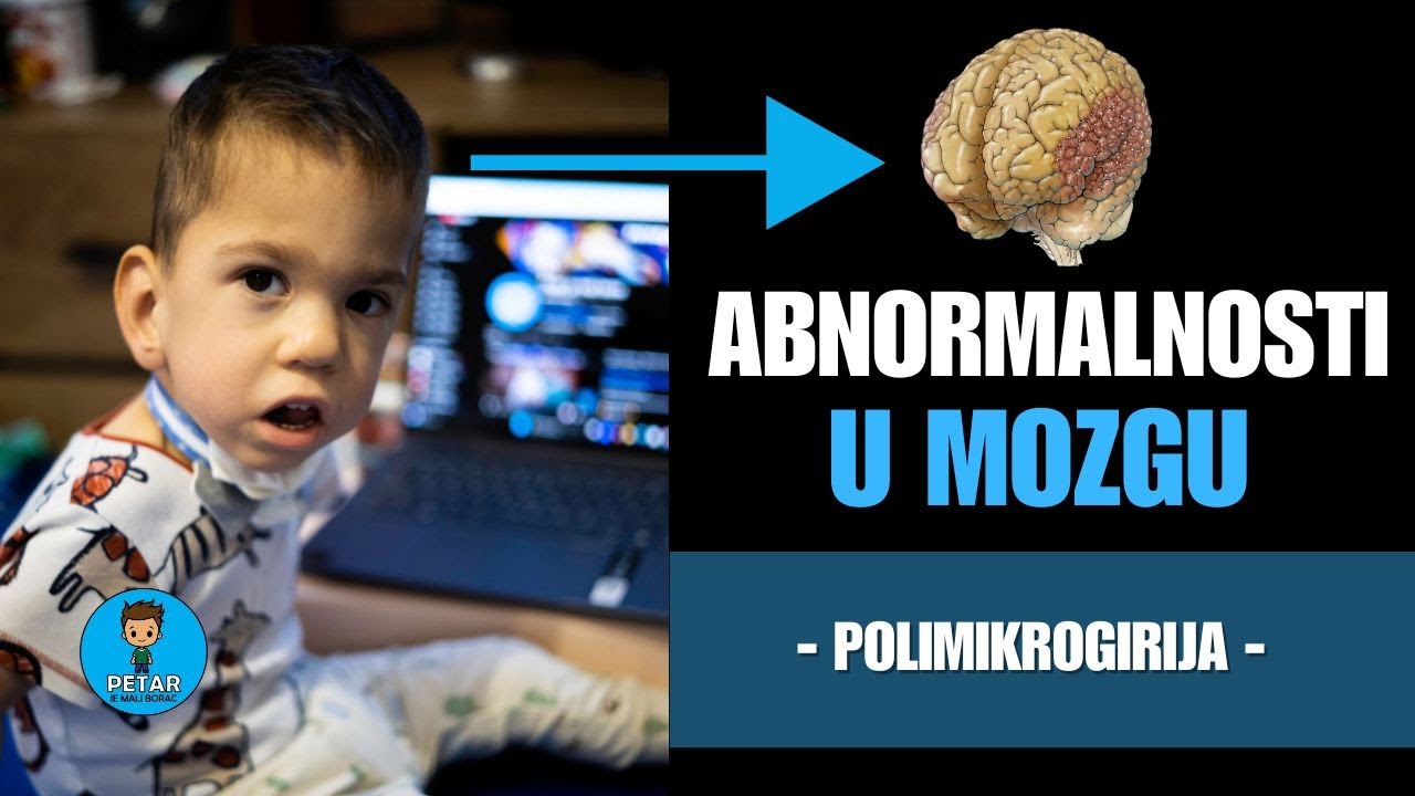 Polimikrogirija | Poteškoće u razvoju