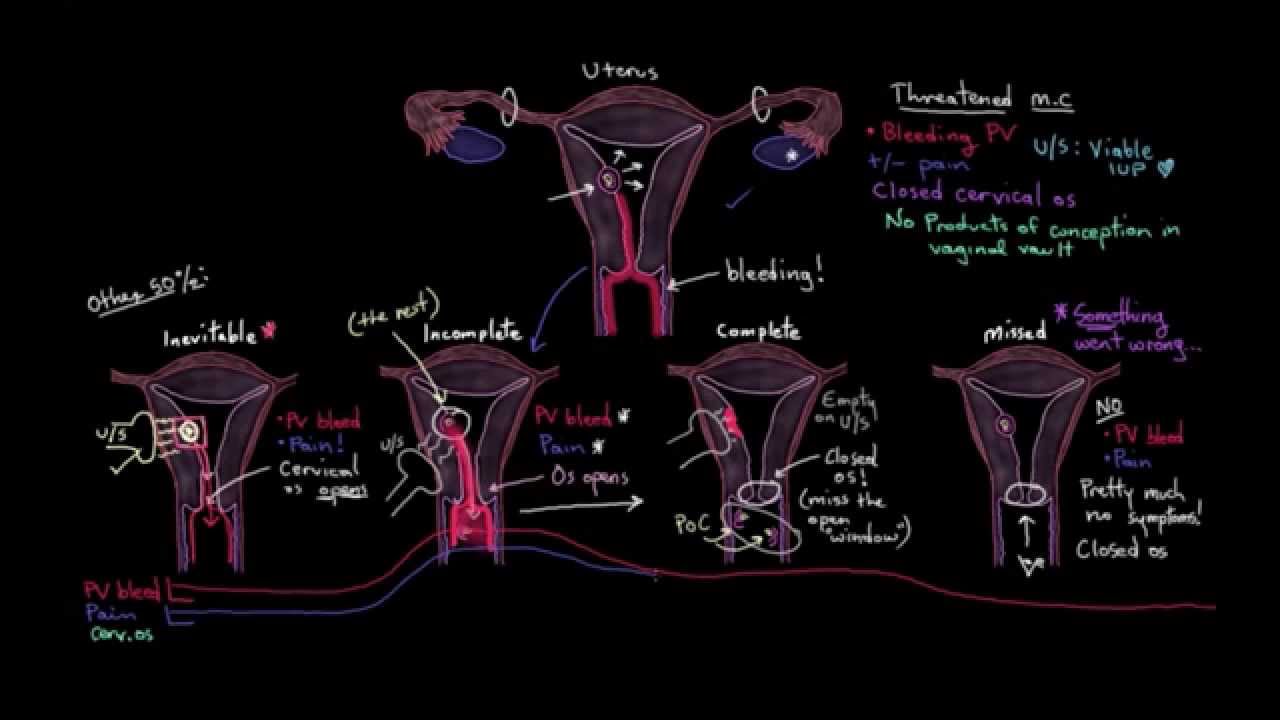 Miscarriage Basics and Types