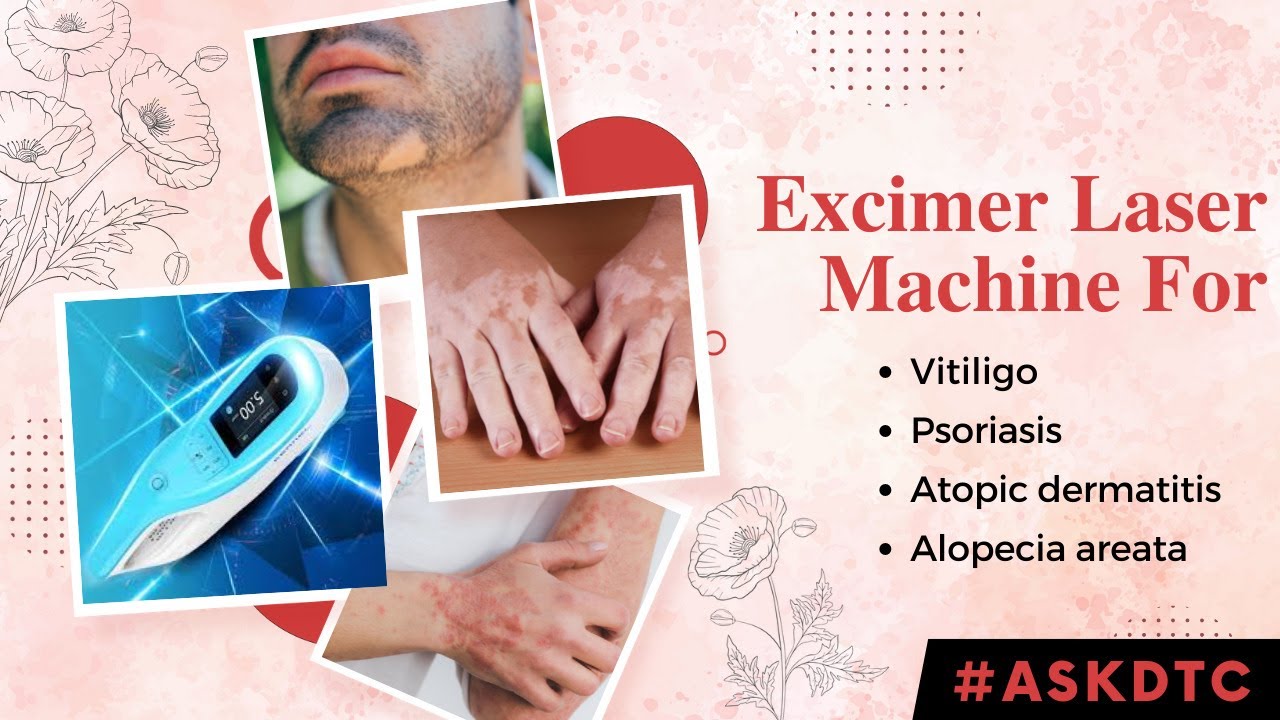 Excimer Laser Treatment for Vitiligo & Psoriasis | Dr. Rohit Goel