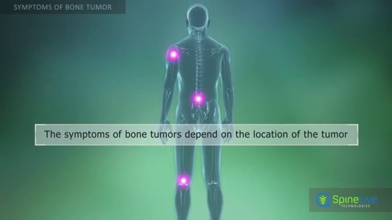 Bone Tumor. Symptoms