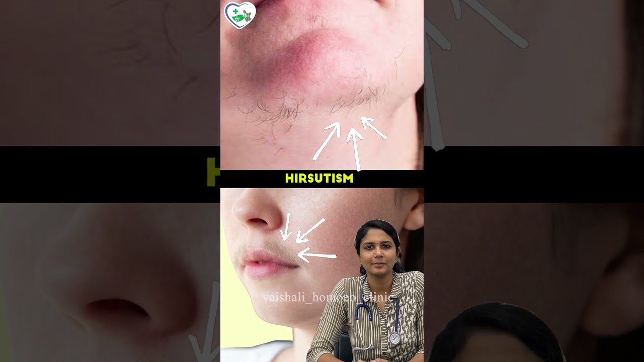 PCOS உங்கள் உடலில் இந்த மாற்றங்களை ஏற்படுத்துமா ?