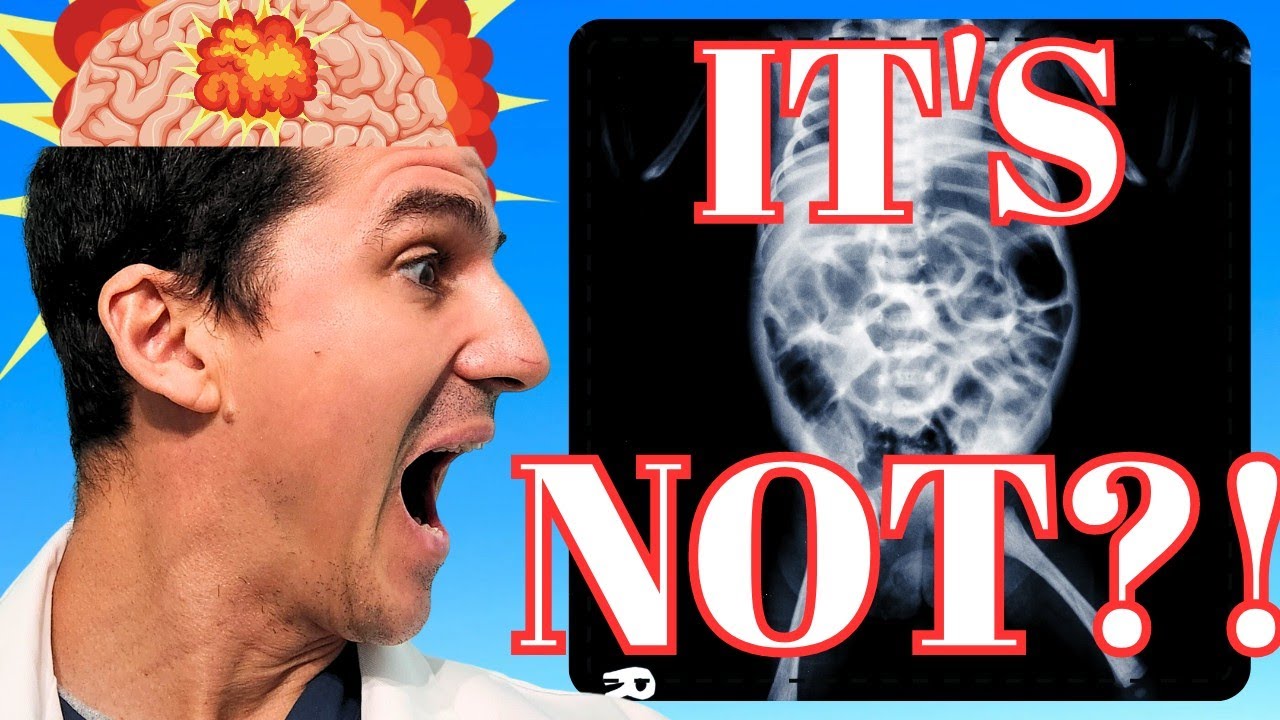 Did you know that NEC really ISN'T an infection?