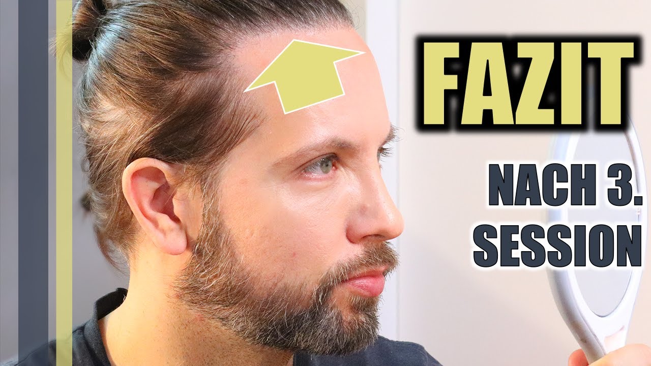SCHON HAPPY NACH MEINER 3. HAARPIGMENTIERUNG ZUR HAARLINIEN VERDICHTUNG? – GREY YOUNG