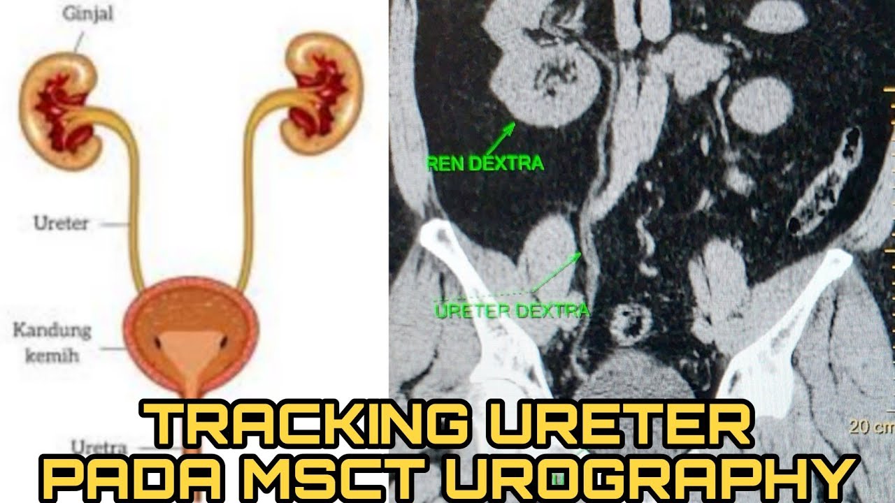 Tracking ureter pada CT Urografi non kontras
