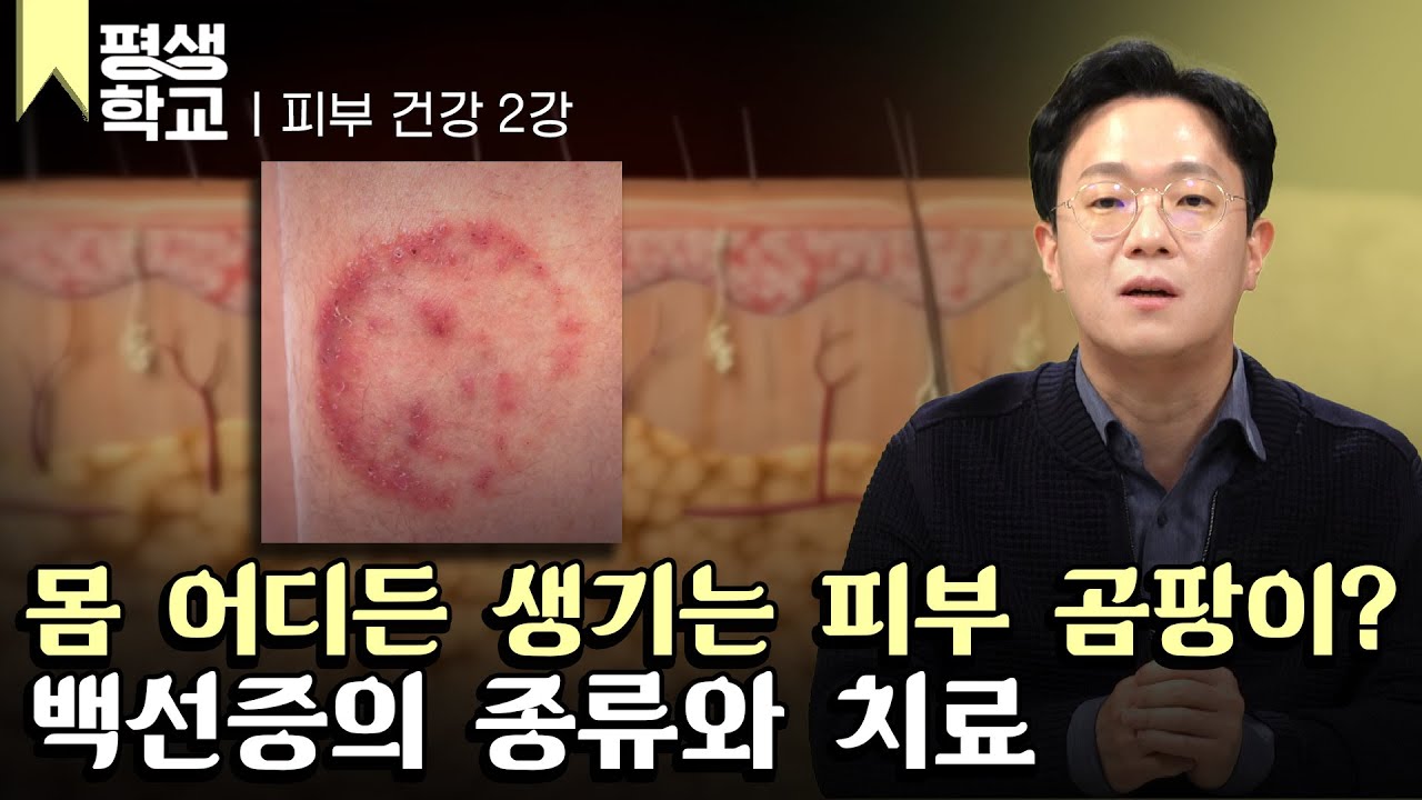 [#EBS평생학교] 2강 피부에 생기는 곰팡이, 백선증│임재우의 친절한 주치의 - 피부 질환
