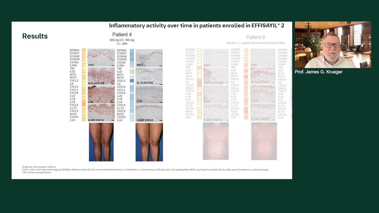 Spesolimab targets IL-36R to alleviate inflammation and reduce generalized pustular psoriasis flares