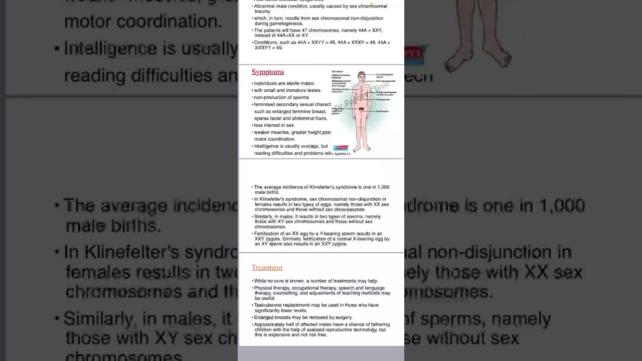 Klinefelters syndrome- Dhanasree NM